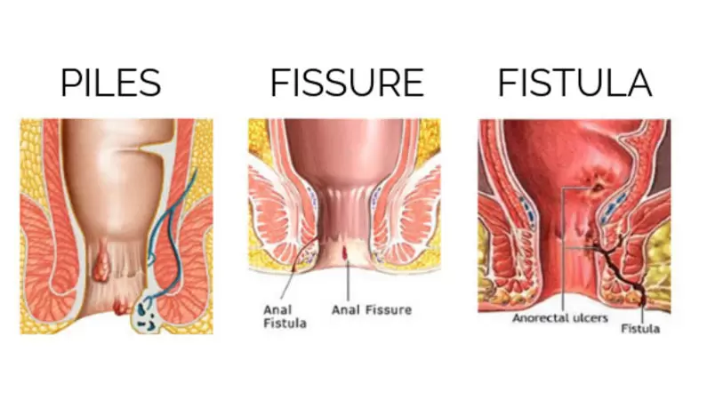 Piles Fissure Fistula