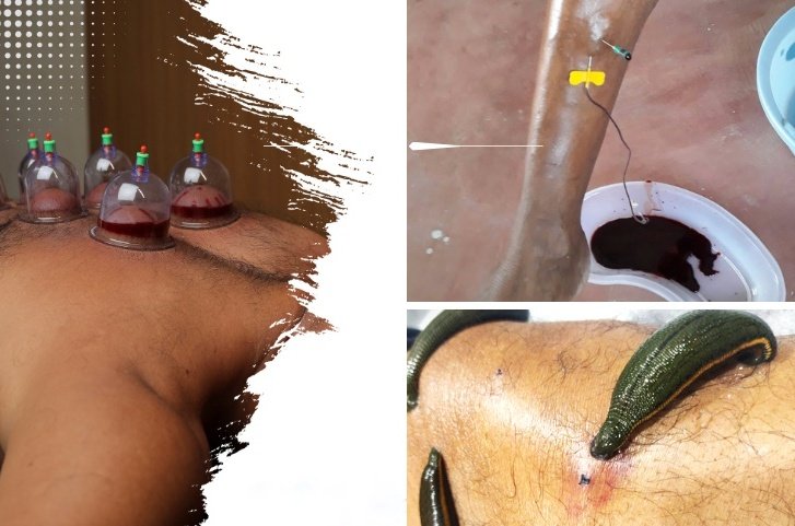 Raktamokshana Therapy