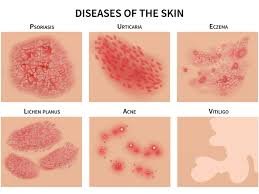 Skin Disorders